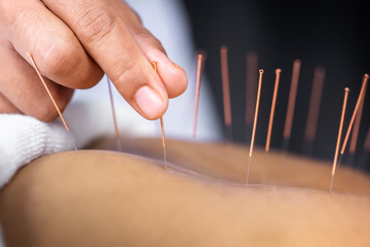Știința desface misterul acupuncturii: cum un ac declanșează sistemul natural de calmare a durerii din corp